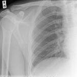 Descobreixen per què un medicament habitual contra l’osteoporosi pot debilitar els ossos Descobreixen per què un medicament habitual contra l’osteoporosi pot debilitar els ossos