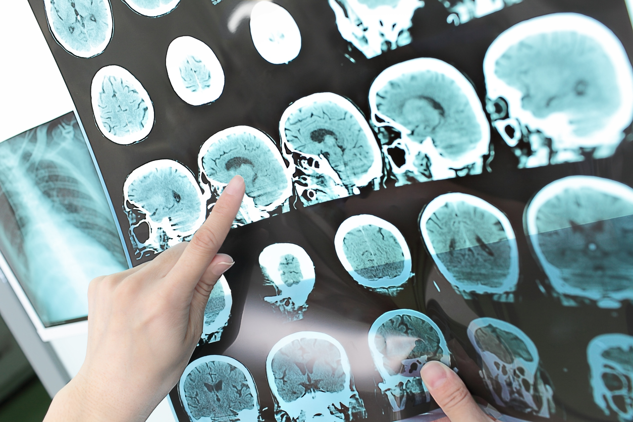 L'esclerosi múltiple és una malaltia neurodegenerativa que afecta a 47.000 persones / IStock